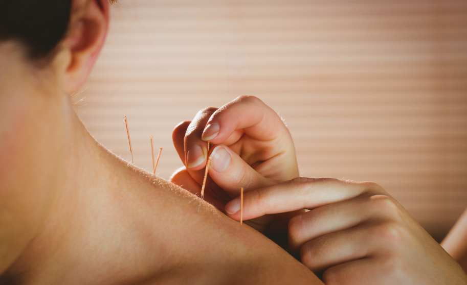 acupuncture-dry-needling-img-04